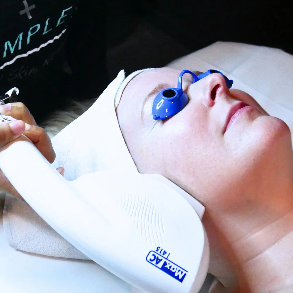 IPL Acne Facial