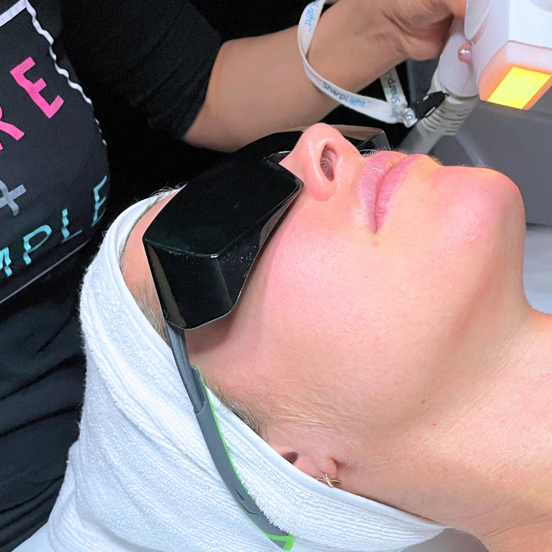 IPL Rosacea Facial